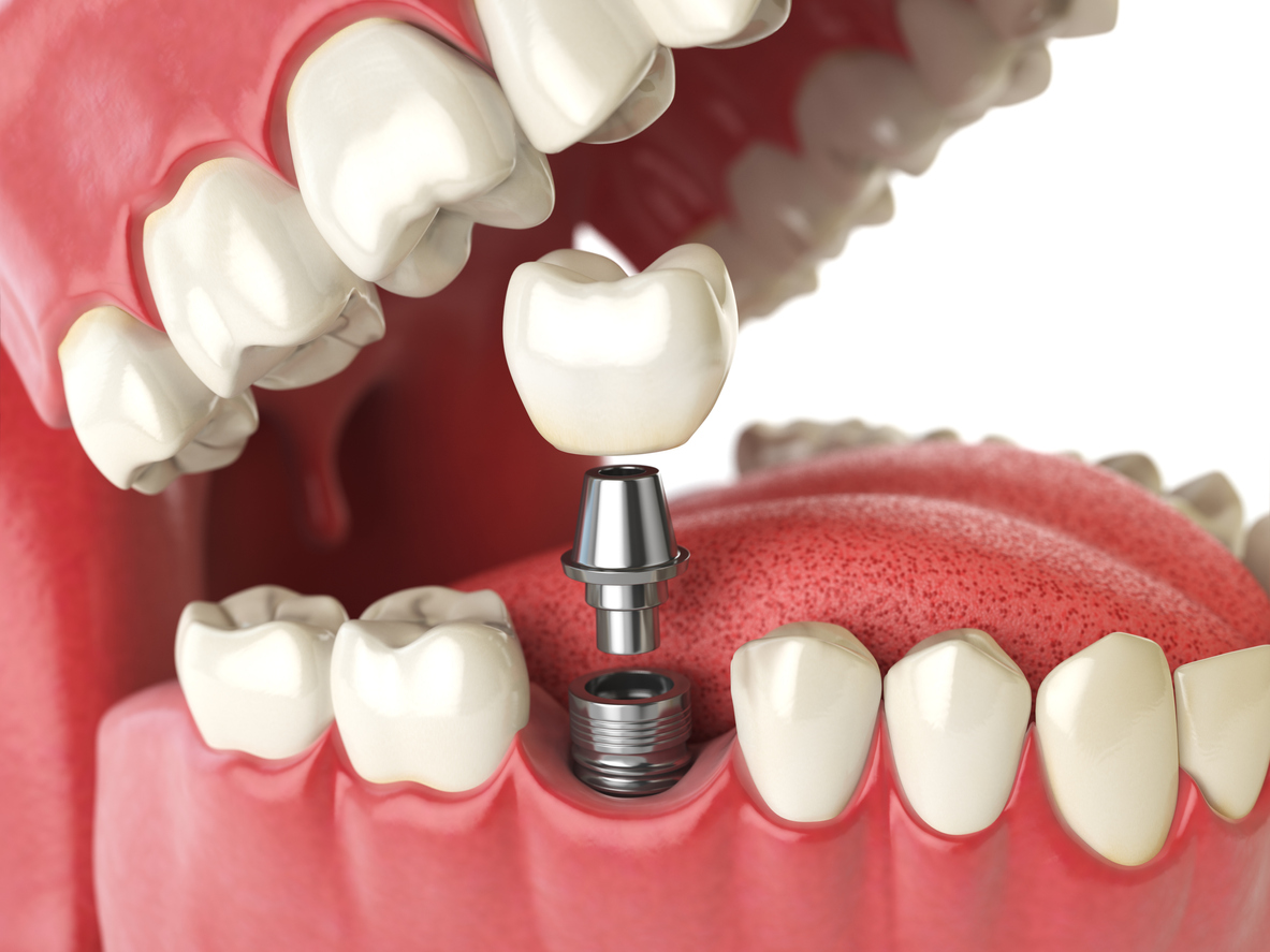 Dental Crown Implants in High Point, NC